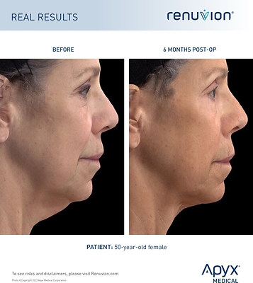RENUVION®&nbsp;CLEARED BY FDA FOR NECK LAXITY PROCEDURES OFFERING PATIENTS A MINIMALLY INVASIVE OPTION TO ELIMINATE SAGGING NECK