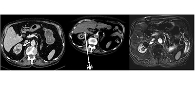 Left - 85-year-old man with 3 cm biopsy-proven clear cell renal carcinoma. Middle - CT showing IceCure cryoprobe in tumor with final ice ball. Right - MRI at 1 month, demonstrating complete local response, no evidence of tumor enhancement