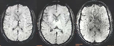 Alzamend Neuro Reports Encouraging Pharmacodynamic Data from Phase II Clinical Trial of AL001 “Lithium in Brain” Study in a Trial Conducted at Massachusetts General Hospital